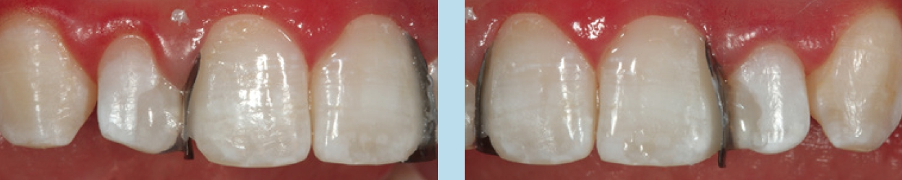 Abb. 34 und 35: Eingebrachte Dentinmasse D1 im distopalatinalen Bereich unter Aussparung des distolabialen Anteils für die Schmelzmasse.