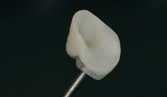 Abb. 29: Mit Al(2)O(3) abgestrahlte e.max-Teilkrone (Entfernung der verbliebenen Kleberreste) vor der Wiederbefestigung. Die Teilkrone ist über ein lichthärtendes Provisoriummaterial (Clip, VOCO) an einem alten Rosenbohrer als Haltegriff befestigt.