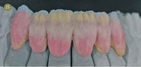 Auftragen der Mamelon-Dentine MD1 und MD2.