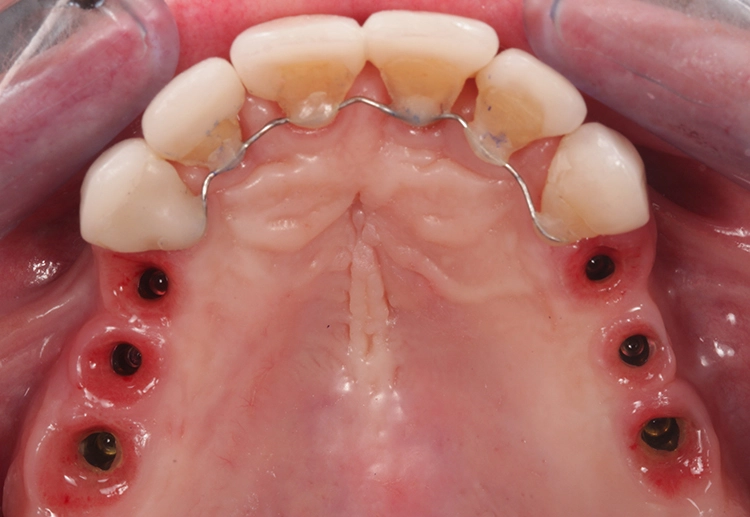 Abb. 29: Eingesetzte Veneers 13-23. Ausgeformtes Weichgewebeprofil 4-6 als Grundlage für die Herstellung der definitiven Implantateinzelkronen.