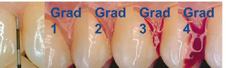 Abb. 2: Mit dem Papillen-Blutungs-Index [13] kann die Entzündung der interdentalen Zahnfleischpapille in 4 Graden erfasst werden.