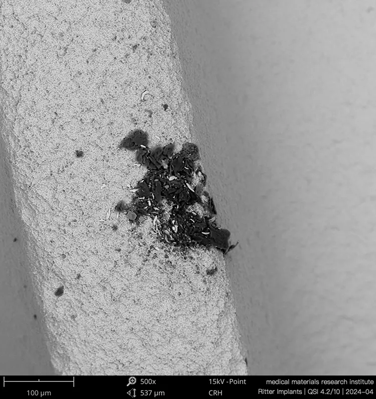 Abb. 2 (links) und 3 (rechts): Kohlenstoffhaltige Verunreinigung mit zusätzlichen metallischen Fremdkörpereinlagerungen auf einem Titanimplantat (links REM 500x, rechts REM 2.500x und Ergebnis der Elementanalyse).