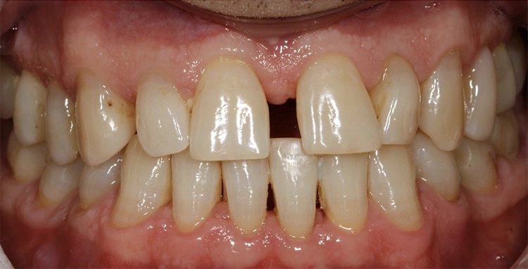 Abb. 5a: Ausgangsdokumentation en-face 2014.