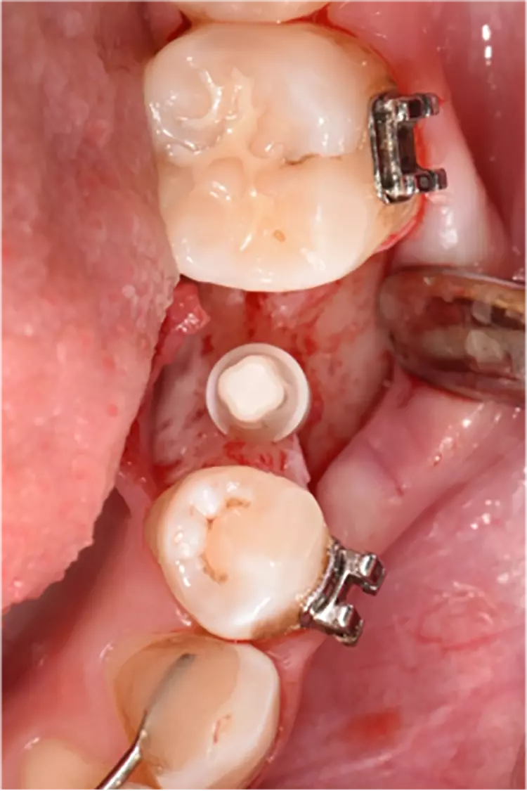 Abb. 2c: Implantat in Endposition.