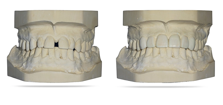 Abb. 5c: Analoges Simulationsmodell Wax-up.
