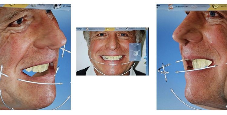 Abb. 5e: CAD-Konstruktion im virtuellen Umfeld des Smile Designer.