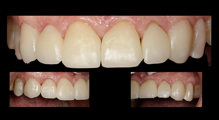 Abb. 5i: Einprobe der Veneers und finale Modifikationen.