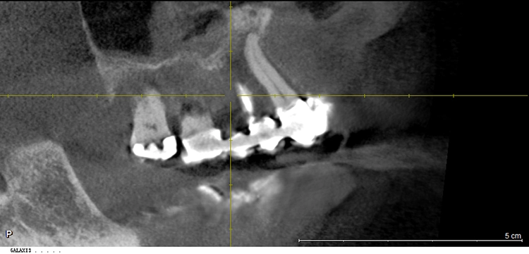 Abb. 3: Ausgangsbefund, Ausschnitt DVT.
