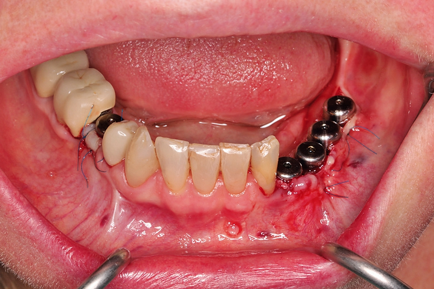 Abb. 30: Lateraler Verschiebelappen bei der Implantatfreilegung.