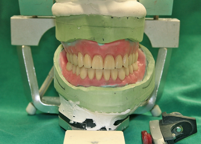 Abb. 25: Überprüfung der Gesamtaufstellung im Artikulator.