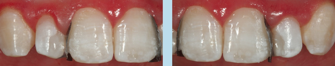 Abb. 36 und 37: Aufbringen weißer Akzentuierungen auf die Dentinmasse an Zahn 11 und 21.