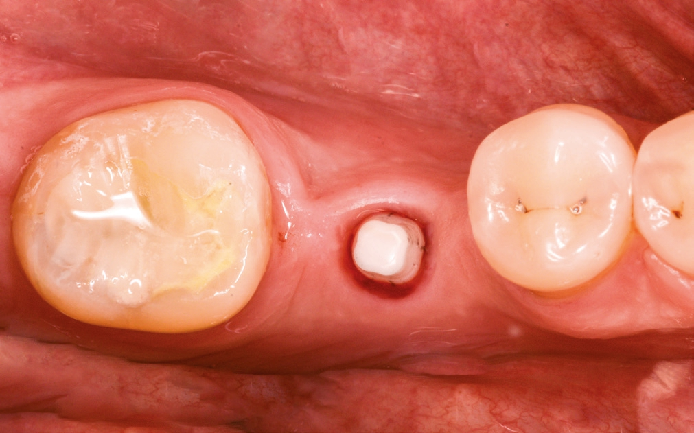 Abb. 30: Die ausgeformte und entzündungsfreie Gingiva von okklusal.