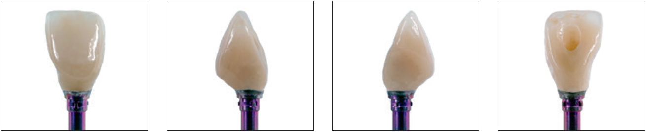 Abb. 29–32: Da dieses Langzeitprovisorium über mehrere Monate zur Modellation der approximalen Papillen und der marginalen Gingiva an prominenter Position getragen wird, ist neben einer korrekten Form und Funktion auch eine ästhetisch überzeugende Rekonstruktion erforderlich. Die Ansicht aus unterschiedlichen Blickwinkeln zeigt das auszuformende Durchtrittsprofil von allen Seiten.