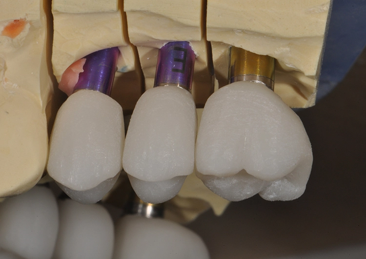 Abb. 30: Einzelzahnrestaurationen 4-6 nach Pressvorgang aufgepasst auf Titanabutments (Lithiumdisilikat IPS e.max Press, Ivoclar und Universal Base Abutments, Nobel Biocare).