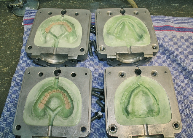 Abb. 26: Einbettung der aufgestellten Zähne.