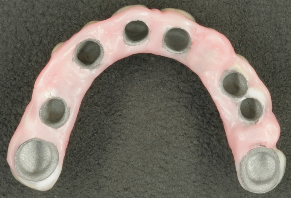 Abb. 31: Für die intraorale Verklebung vorbereitete Tertiärkonstruktion.