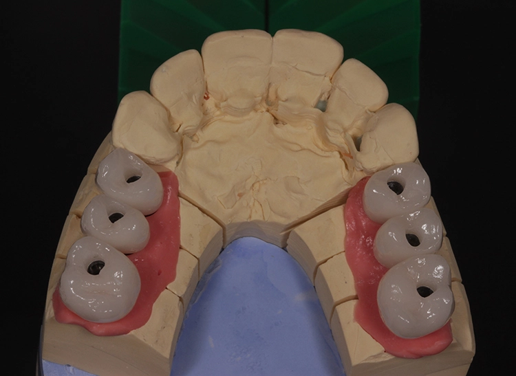 Abb. 31: Fertig ausgearbeitete und glasierte Implantatkronen verklebt mit Multilink Hybrid-Abutment (Ivoclar).
