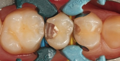Abb. 32: Direkte Überkappung des Zahnes. Gut erkennbar die angelegten Teilmatrizen, mit zwei gegenläufig ausgerichteten Palodent V3-Spannringen.