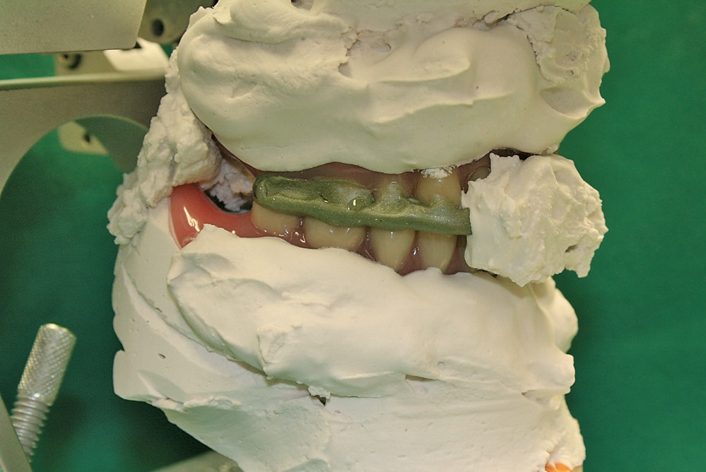 Abb. 27: Die Montageverschlüsselung im Artikulator. Für diese Arbeit und die Remontage gilt: In dieser üppigen „barock“ anmutenden Art wird in Praxen oft Gips aufgestrichen – nicht sparsam und bilderbuch-schön wie im Studium gelernt. Die Bilder geben das Alltagsgeschäft wieder.