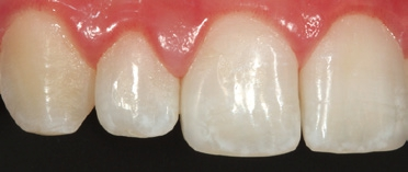 Abb. 39: Nachkontrolle in derselben Perspektive wie aus Abb. 38 nach sechs Monaten: Aufgrund der immer noch insuffizienten Mundhygiene persistierte die bereits auf dem Ausgangsbild erkennbare Gingivitis.