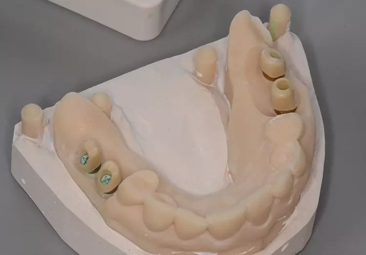 Abb. 32: Abutments auf Modell.