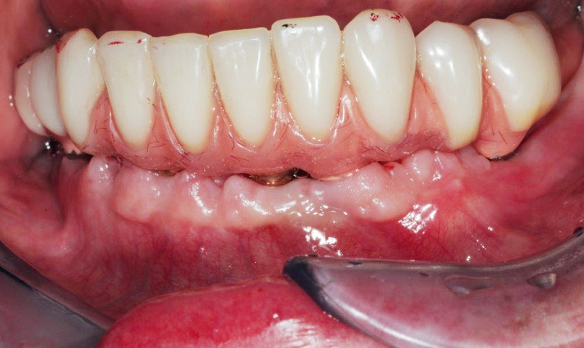 Abb. 33: Gingivaverhältnisse nach zwei Wochen.