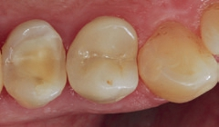 Abb. 33: Die erneut mit Adhese Universal (nach Phosphorsäurekonditionierung der Schmelzflächen) und Variolink Esthetic DC befestigte e.max-Teilkrone in Ansicht von okklusal.