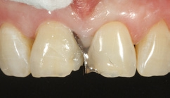 Abb. 33: Dentinmasse D3 im palatinalen Anteil der Kavität.