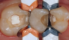 Abb. 33: Die Formgebung der Approximalflächen und die erforderliche Separation durch Teilmatrizenfolien, Kunststoffkeilchen und Separationsringen.