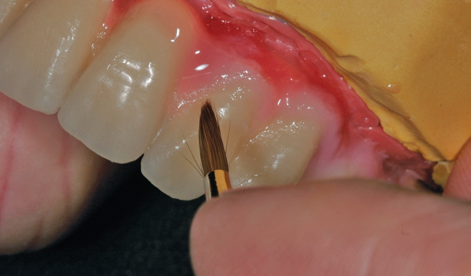 Abb. 34: Individuelle Charakterisierung der Gingiva mittels fließfähigem Komposit.