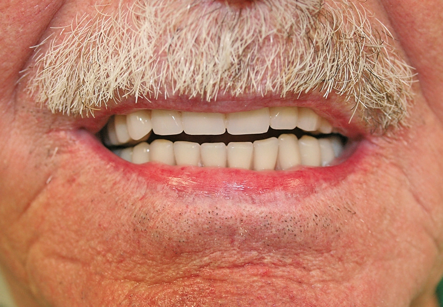 Abb. 29: Patient mit neuer TOK-TUK. Die gut eingestellte Funktion und Ästhetik werden ihm eine Bereicherung sein.