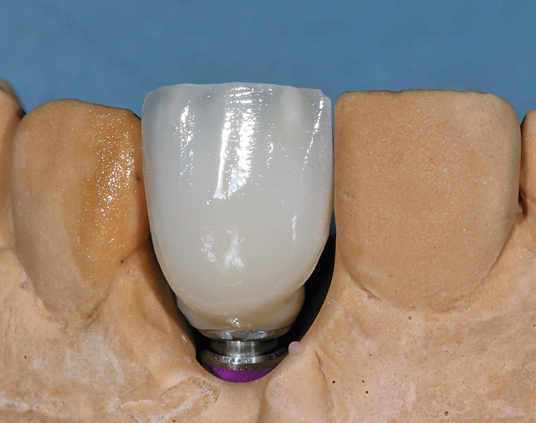 Abb. 32: Die Krone nach dem ersten Dentinbrand.