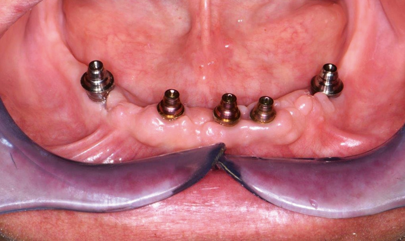 Abb. 34: Gingivaverhältnisse nach 3 Monaten.