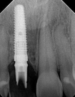 Abb. 36: Das Kontrollröntgen nach 6 Monaten zeigt eine gute und stabile Osseointegration des Implantats.