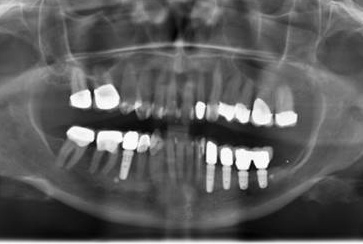 Abb. 35: Das abschließende Röntgenbild zeigt trotz kompromittierter Weichgewebsheilung regelrechte periimplantäre Knochenstrukturen.