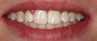 Abb. 42: Lippenbild der abgeschlossenen Versorgung bei der 6-Monats-Kontrolle.