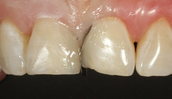 Abb. 36: Dentinmasse D3 im palatinalen Anteil der Kavität.