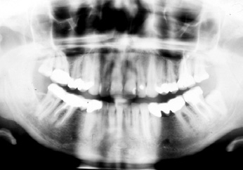 Abb. 32: Das OPG zeigt die endodontische Versorgung im UK und die Verlagerung und Retention von 38; es lag ein Parodontaldefekt am Zahn 36 im Bereich der Bifurkation vor.