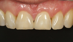 Abb. 37: Abschlussbild bei einer Nachkontrolle nach 4 Wochen. Neben der Dentinmasse D3 kamen die Universalfarbe A3 und die Schmelzeffektmasse E1 zur Anwendung.