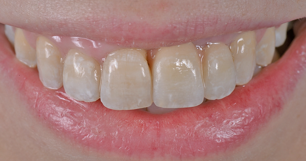 Abb. 34a: Der Zahnersatz mit approximal rosa Keramik im Lippenbild.
