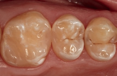 Abb. 37: Minimalinvasives Behandlungsergebnis bei einem Kontrolltermin nach zwei Wochen.
