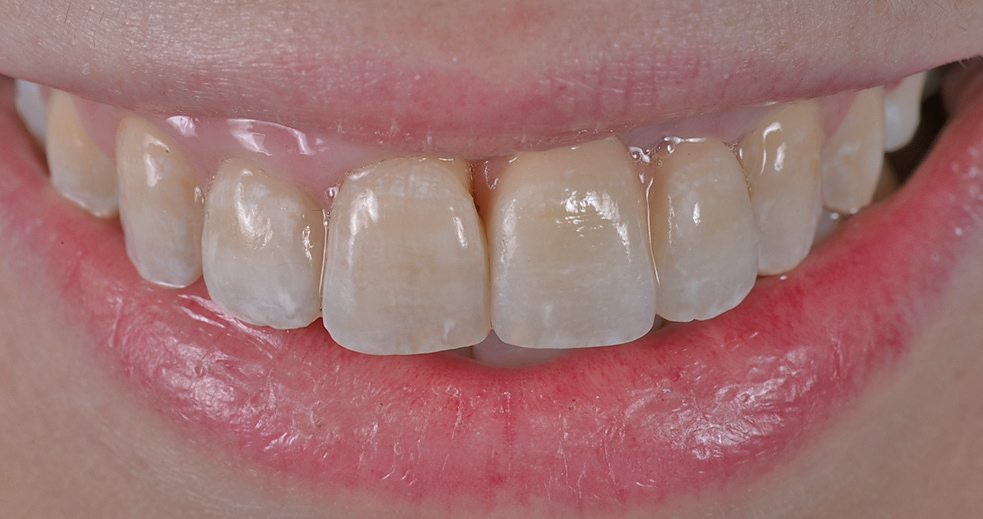 Abb. 34a: Der Zahnersatz mit approximal rosa Keramik im Lippenbild.