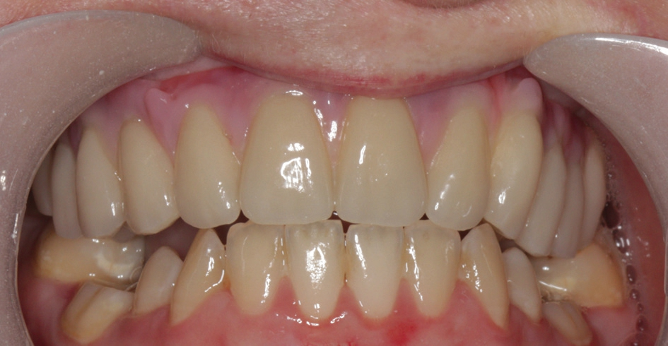 Abb. 38: Eingegliederte Restauration von frontal.