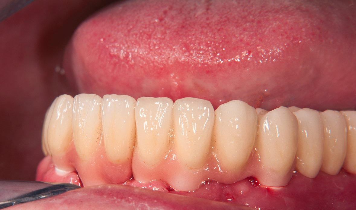 Abb. 39: Ansicht der Versorgung von labial.
