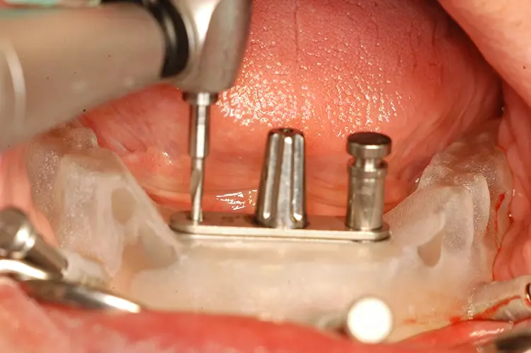 Abb. 3: Präparation des Implantatbettes mit einer individuellen Schablone.
