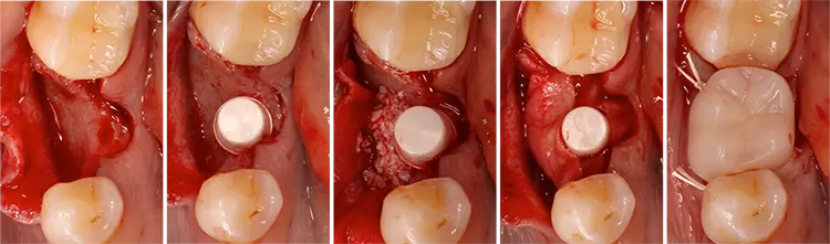 Abb. 3: Versorgung regio 46 mit einem 1-teiligen Zirkonoxidimplantat (Fallbeispiel aus der klinischen Studie „FR/ZH“, Dr. T. Hitz, Universität Zürich)
a: Schnittführung. b: Implantat in Endposition. c: Augmentation. d: Membran gelegt. e: Provisorische Versorgung und Wundverschluss.