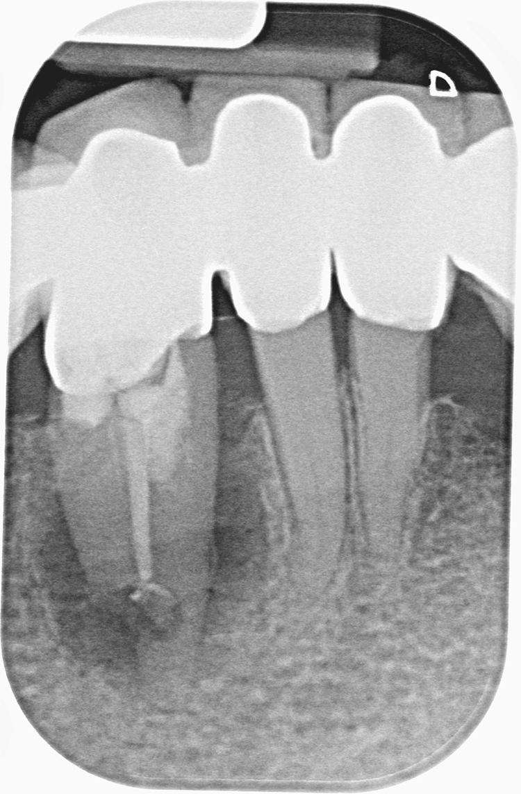 Abb. 3: Endodontische Versorgung des Zahnes 43 nach vorangegangenen rezidivierenden
parodontalen Beschwerden.