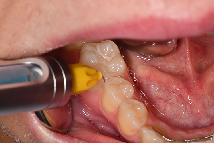 ILA im UK-Molarenbereich als Alternative zur invasiveren Leitungsanästhesie des N. alveolaris inferior, z.B. bei antikoagulierten Patienten.