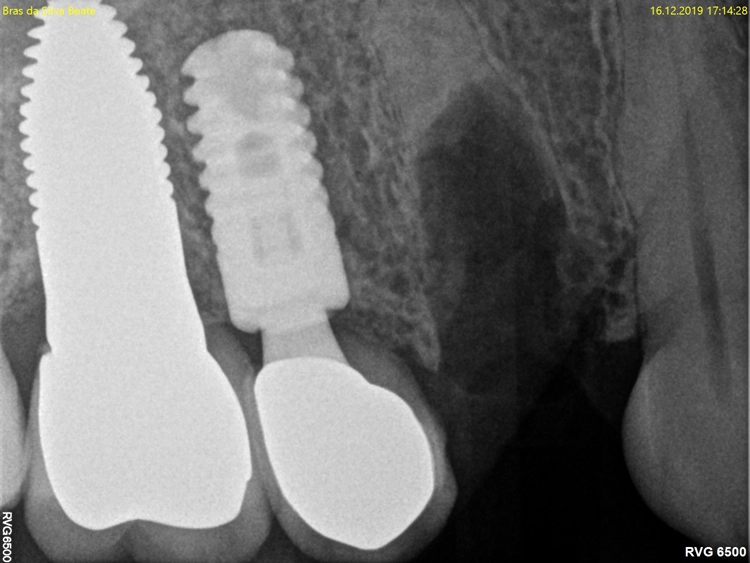Abb. 4: Röntgenbild nach Osteotomie, Wurzelrest wurde noch entfernt.