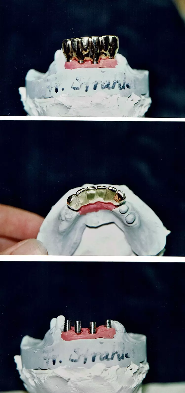 Abb. 4: Januar 2003 – UK-Versorgung: zementierbare Vollgussbrücke auf Implantaten.